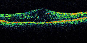 糖尿病黄斑浮腫の網膜断面図